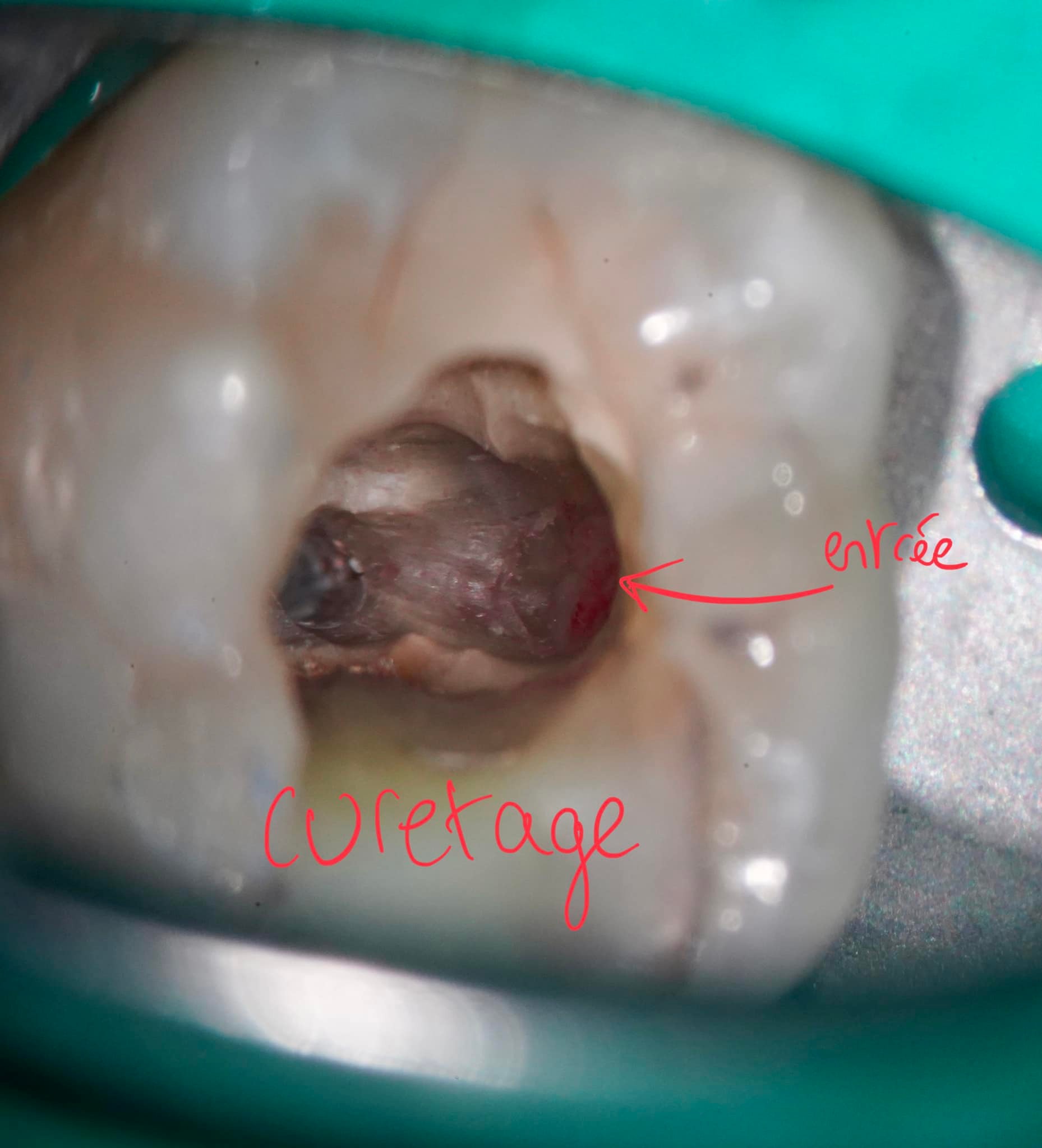 Resorption radiculaire