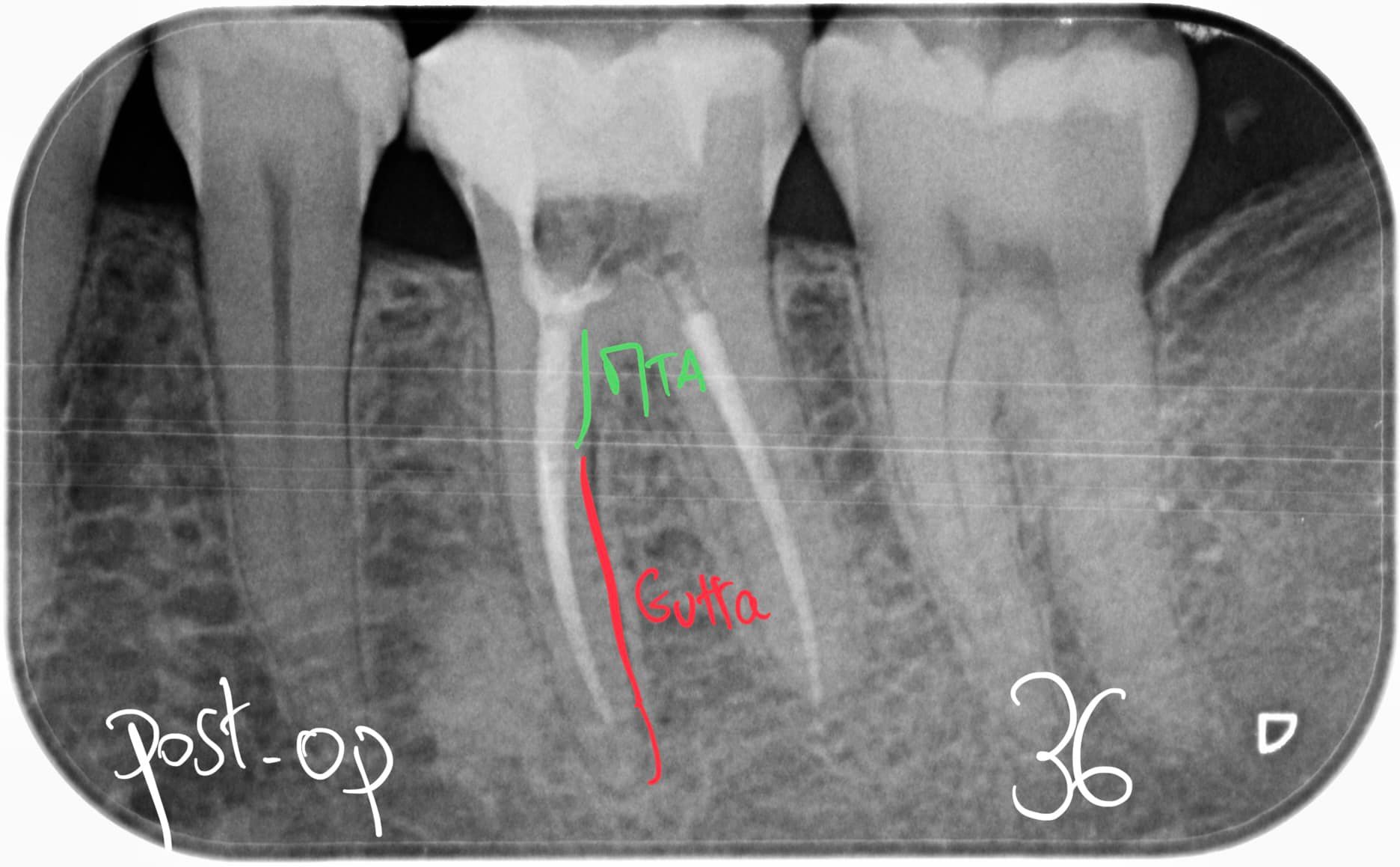 Resorption radiculaire