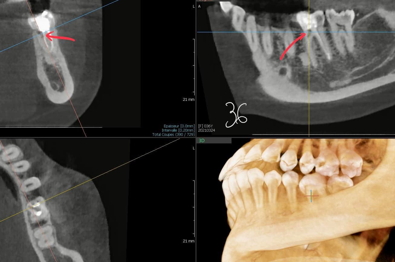 Resorption radiculaire