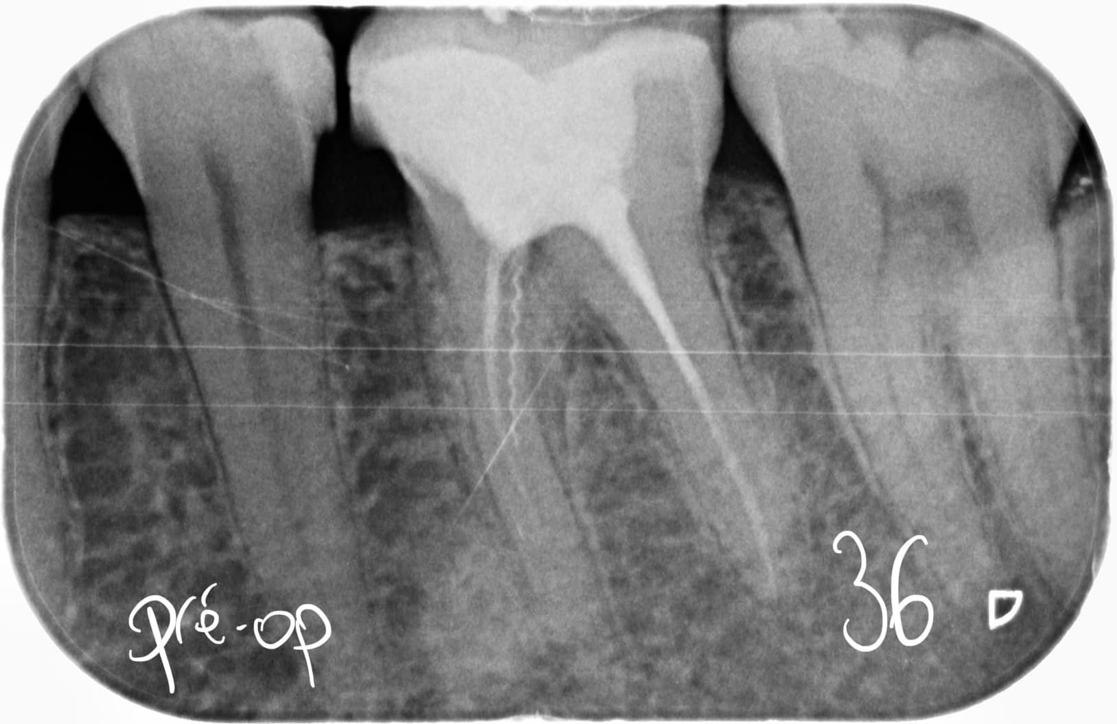 Resorption radiculaire